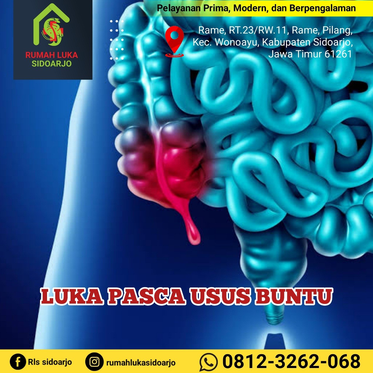 Rumah Luka Sidoarjo, Pusat Perawatan Luka Pasca Operasi Usus Buntu Wiyung Surabaya