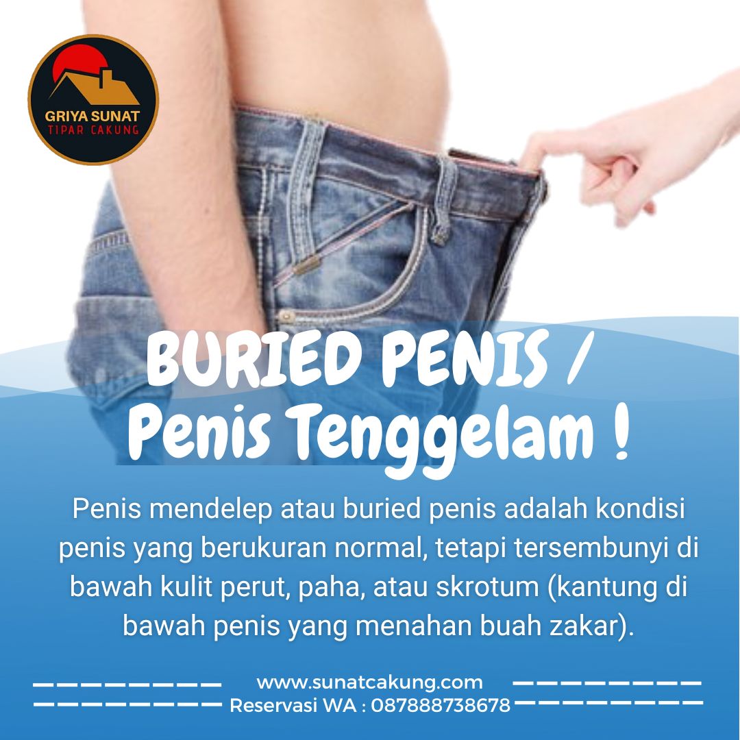 Kasus Buried Penis: Tantangan dalam Proses Sunat Anak