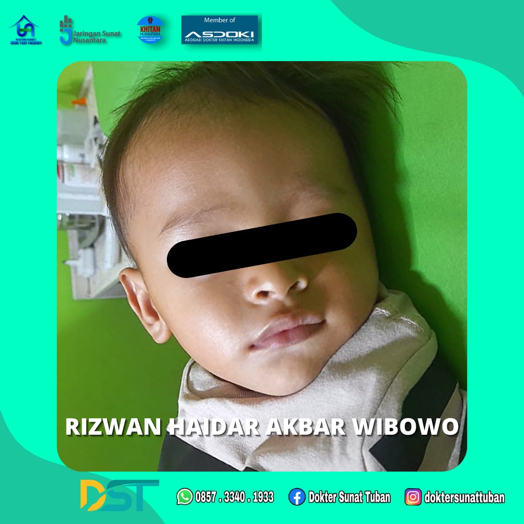 Sunat Bayi Eksklusif: Pengalaman Unik dan Berkualitas di Tuban