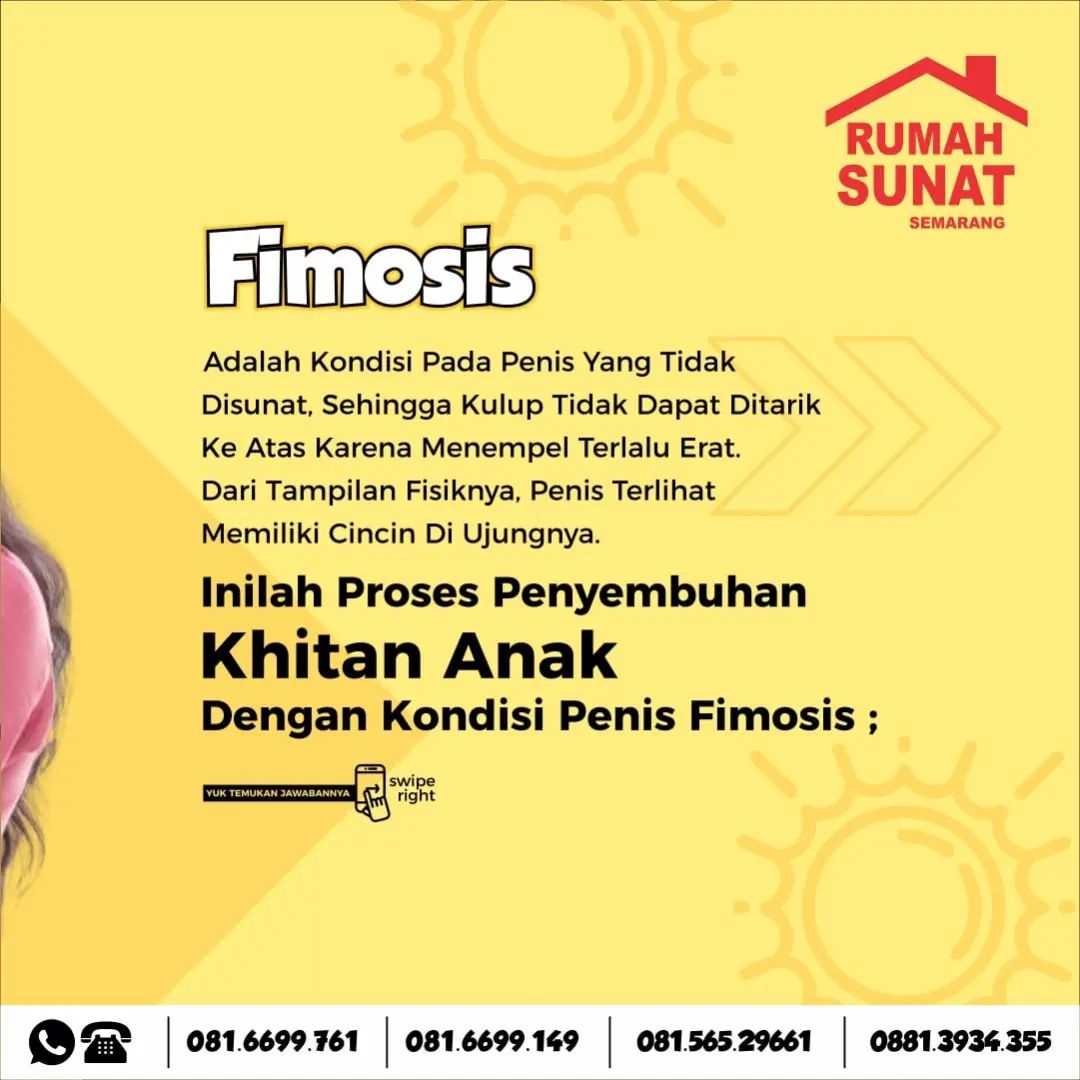 Sunat Anak dengan Fimosis? Yuk, Coba Cara Mudah di Rumah Sunat Semarang!
